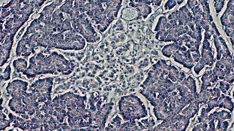 The Hormone That Kept Turning Into Amyloid: Why Amylin Took Thirty Years to Become a Drug